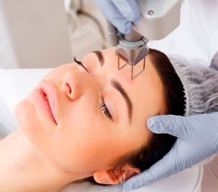 η ουσία της διαδικασίας fractional laser ανανέωσης του δέρματος του προσώπου