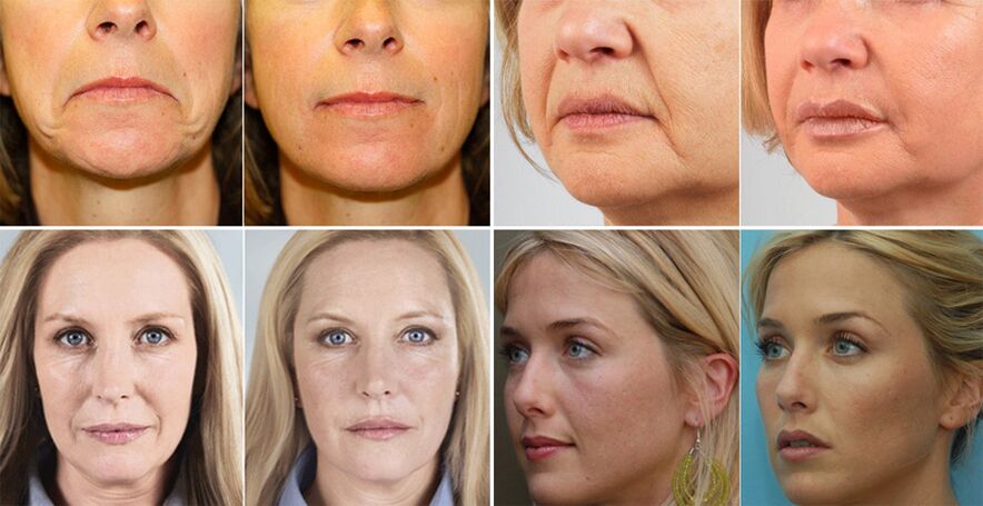 φωτογραφίες γυναικών πριν και μετά την ανανέωση του δέρματος του προσώπου